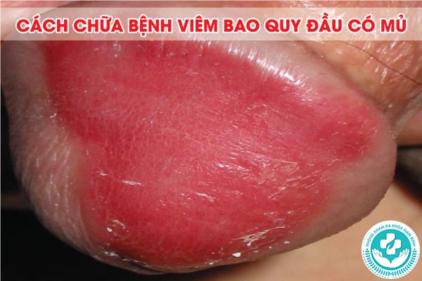 viêm bao quy đầu có mủ
