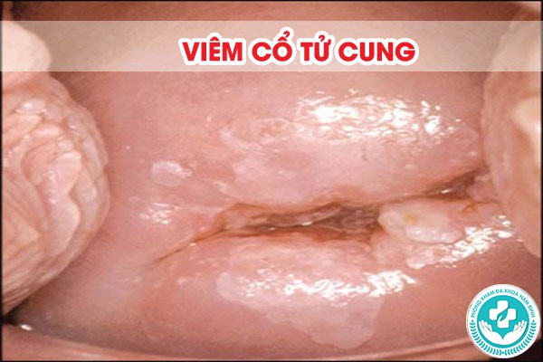 viêm lộ tuyến và viêm cổ tử cung