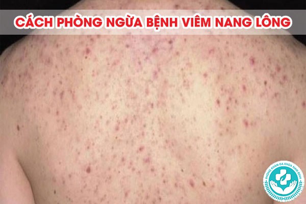 Viêm nang lông Viêm nang lông