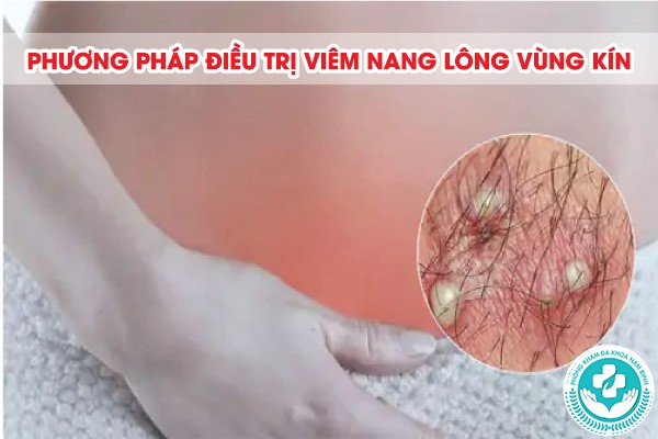 viêm nang lông vùng kín