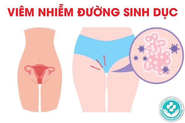 viêm nhiễm đường sinh dục ở nữ