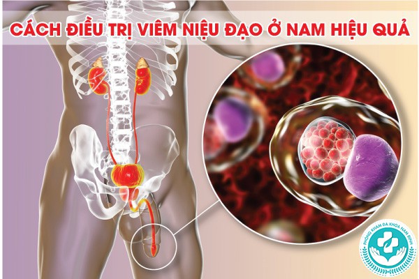 viêm niệu đạo ở nam
