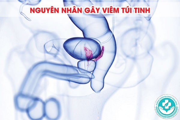 viêm túi tinh viêm túi tinh