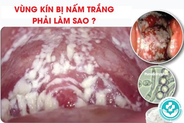vùng kín bị nấm trắng