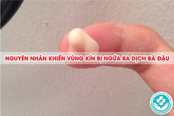 vùng kín bị ngứa ra dịch bã đậu