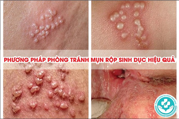 xét nghiệm bệnh mụn rộp sinh dục