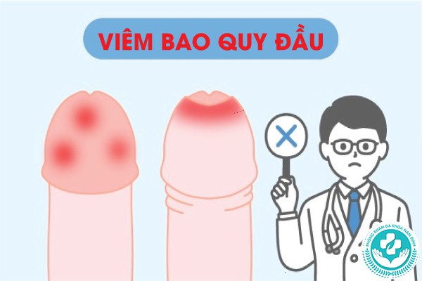 xuất hiện mủ trắng ở bao quy đầu xuất hiện mủ trắng ở bao quy đầu